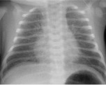 chest newborn